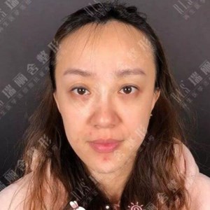 瑞麗舍整形馬君做的全臉自體脂肪填充，不錯呢~