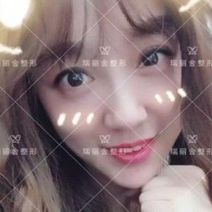 瑞麗舍整形馬君做的全臉自體脂肪填充，不錯呢~