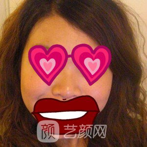 上海華美謝衛(wèi)國耳軟骨隆鼻三個月日記分享~