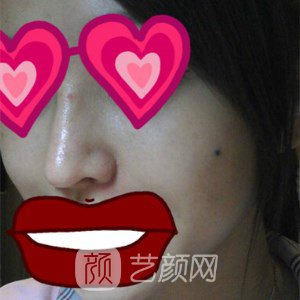 上海華美謝衛(wèi)國耳軟骨隆鼻三個月日記分享~