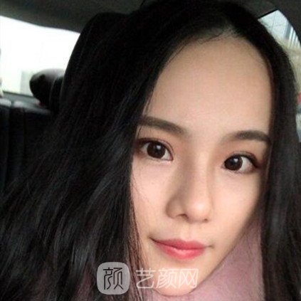 重慶聯(lián)合麗格王巖玻尿酸隆鼻三個(gè)月了，分享果照片~